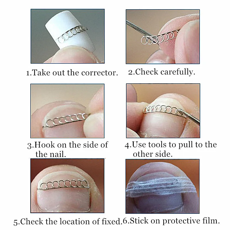 6 шт. коррекция вросших пальцев ног педикюр проволока из нержавеющей стали