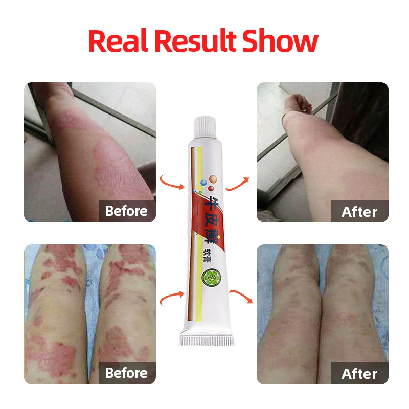 Натуральный травяной медицины псориаз мазь антибактериальные дерматит зуда для