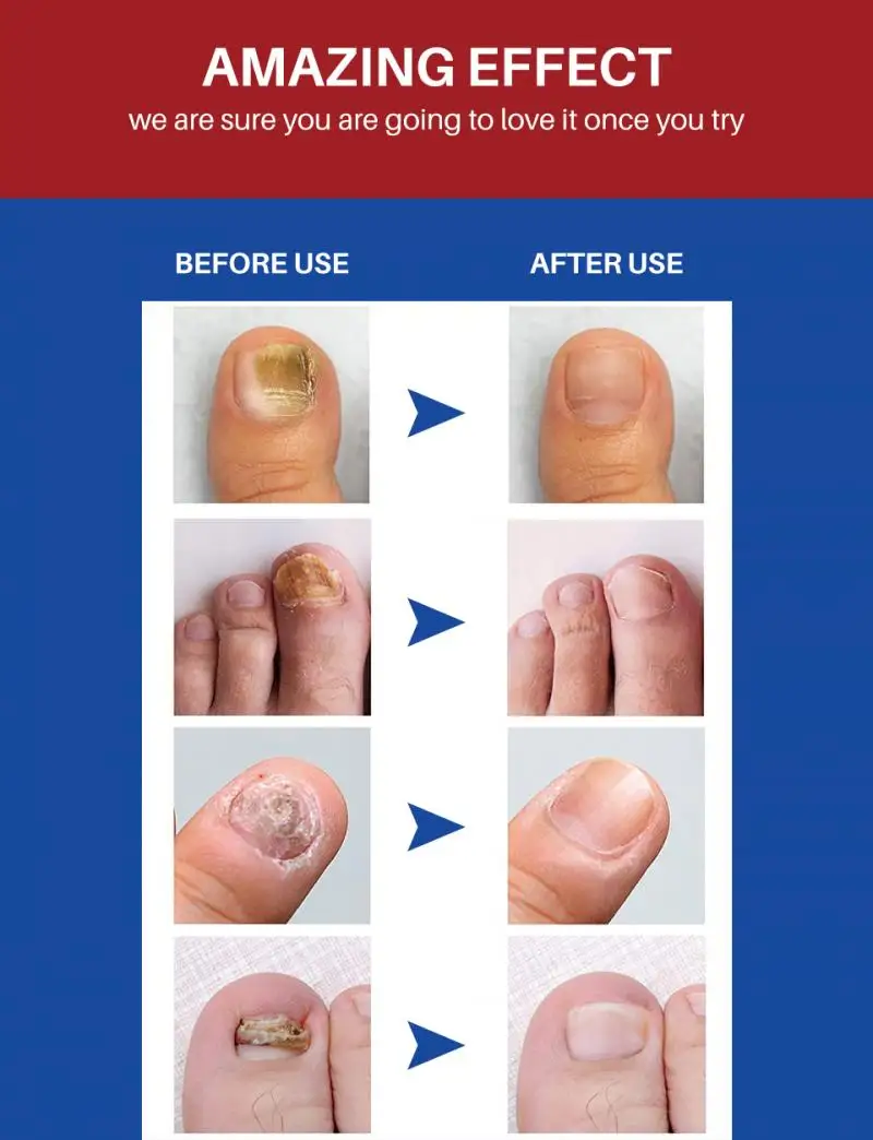 

Nail Repair Liquid Fungal Repair Essence Serum Treatment Nails Care Liquid Anti Infection Paronychia Fungus Removal Gel Nail Art