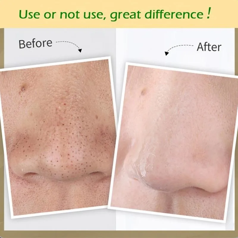 

Blackhead Nose Mask Nose Sticker Acne Treatment Deep Skin Black Control Oil Tool Mask Care Cleansing D1U2