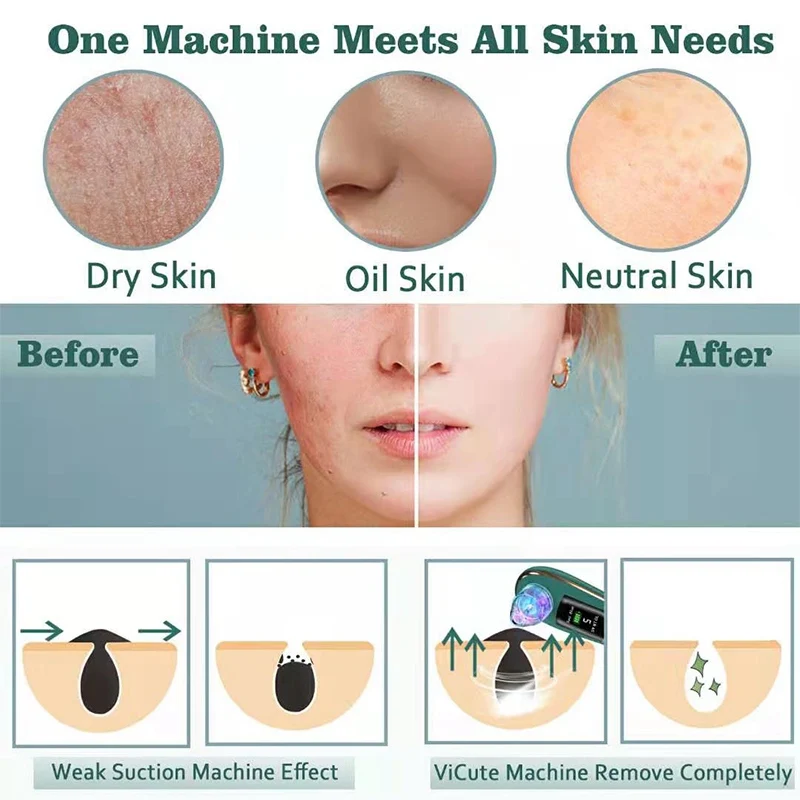 

Ultrasonic Mini HIFU Skin Rejuvenation RF Face Lifting Beauty Machine With Blackhead Remover Facial Pore Cleaner Skincare Tools