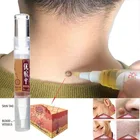 Новый набор для удаления бородавок на ногах, бактериостатический набор для быстрого удаления бородавок и гениталий за 8 часов