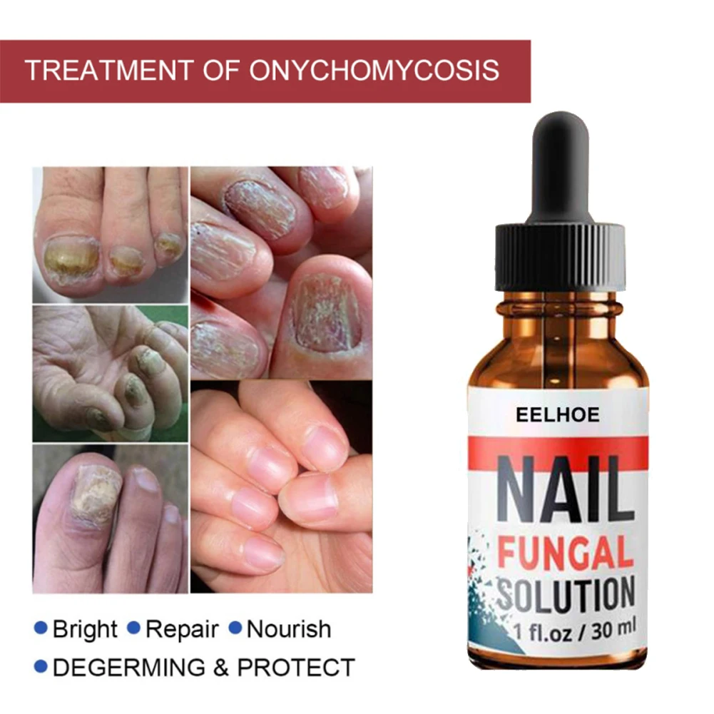 

20/30ml Nail Repair Serum Essences Fungal Care Treatments Foot Nail Fungus Removal Gel Anti-infective Paronychia Onychomycosis