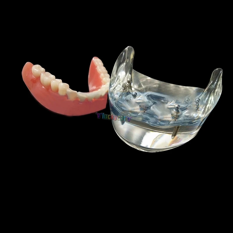 

1 шт Высокое QualityDental 4 Имплантат модель исследования зубов Overdenture уступает демонстрационные модели