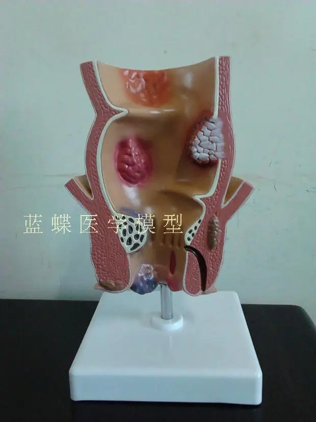 5-кратная анатомия человека модель поражения ректального геморроя внутренняя