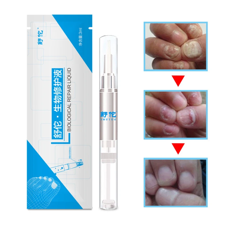 3ml Nail Fungus Treatment Liquid Anti Fungal Finger Toe Nails Care NShopping