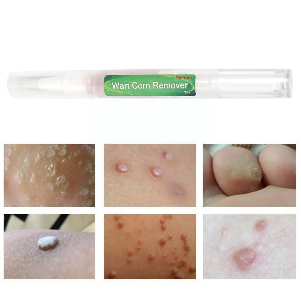 

Body Warts Treatment Cream Skin Tag Remover Wart Corn Corns Cream 3ml Care Patch Foot Remover Light Wart Net Foot Flat D1C1
