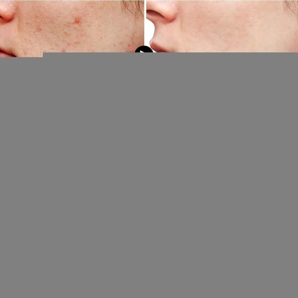 

Tea Tree Acne Cream Effective Acne Removal Cream Treatment Control Shrink Fade Moisturizing Acne Oil Cream Skin Care Pores G0F0