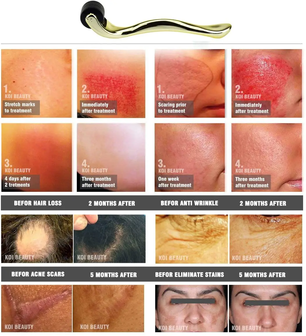 

TBPHP Microneedling Titanium 540 Needles Derma Roller 0.25 - 2.0 mm for Hair Loss Wrinkles Scars Stretch Marks Acne