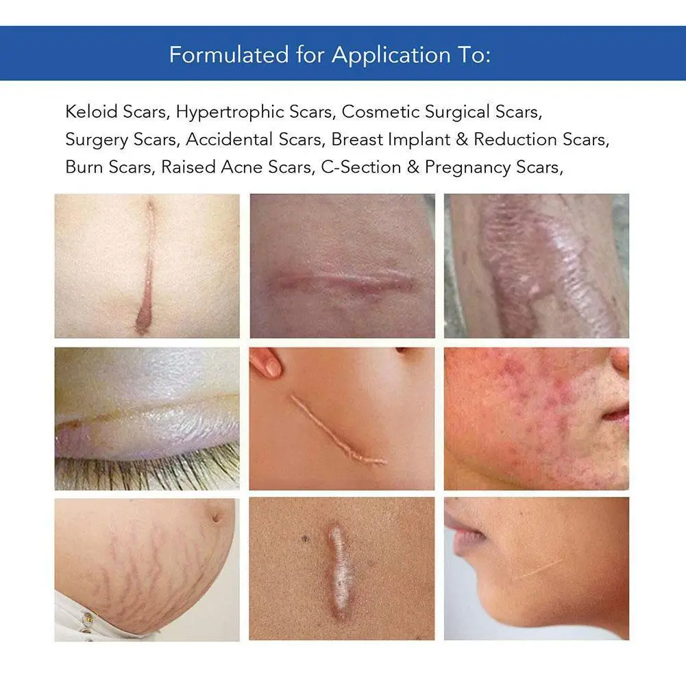 

Surgery Scar Removal Therapy Patch Efficient Silicone Gel Sheet for Acne Trauma Burn Scar Skin Repair Scar Treatment P0V5