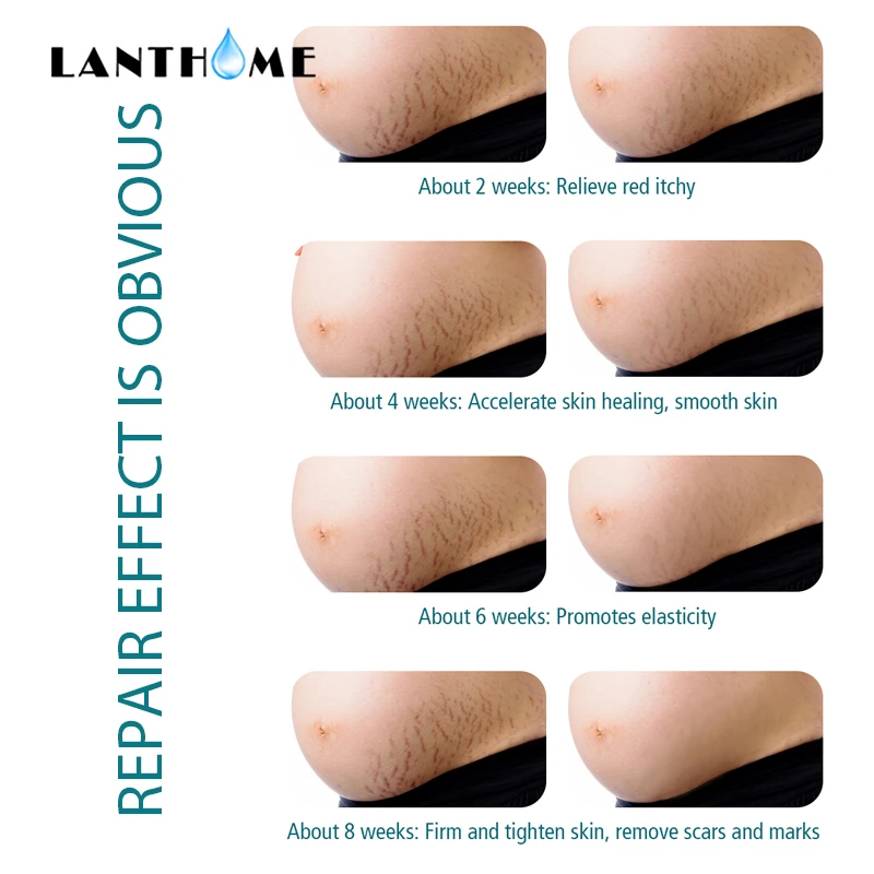 Крем Для Удаления растяжек от акне и шрамов| |