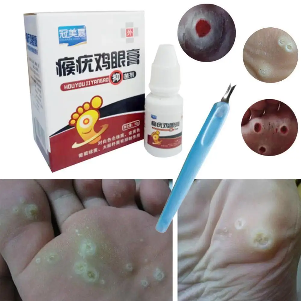 

Skin Tag Remover 12 hours Medical Remover Against Skin Tag Mole