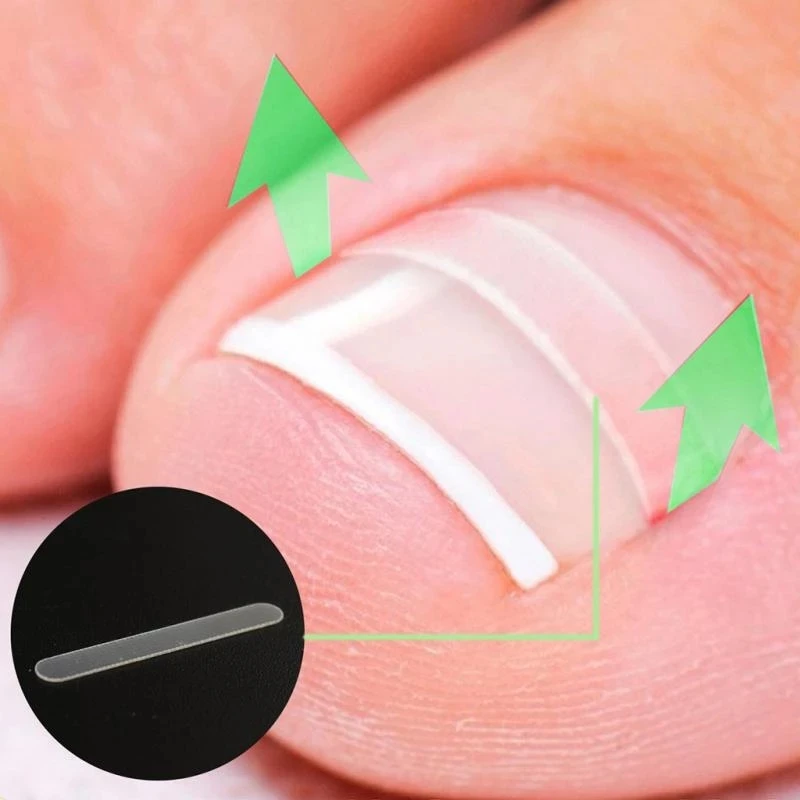 

Silicone Ingrown Toenail Correction Tool Invisible Ingrown Toe Nail Treatment Elastic Straightening Clip Brace Pedicure Tool