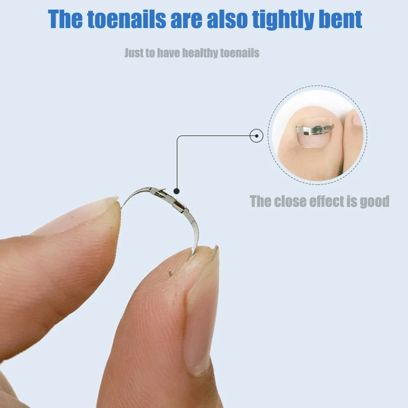 

Good Healthy Ingrown Toe Nail Correction Tool Toenail Straightening Correctors Patch Tool