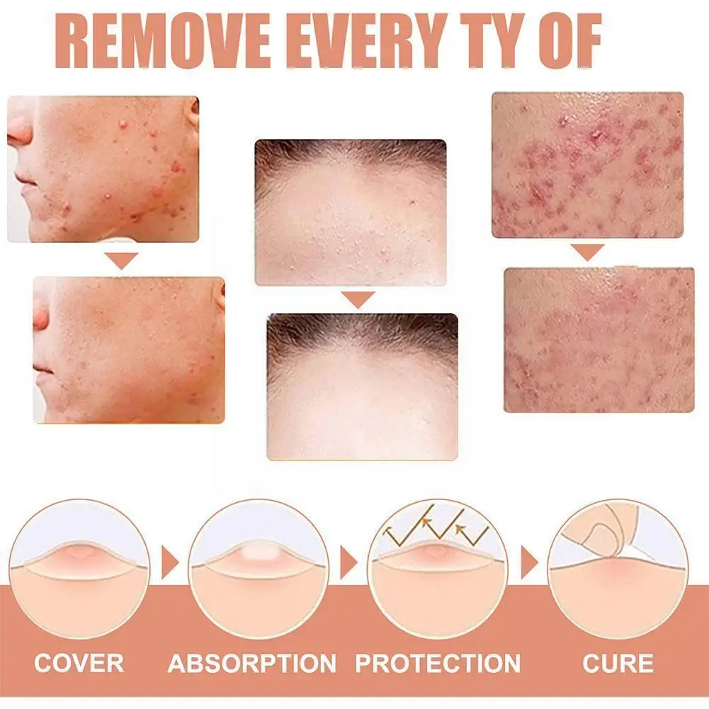 

Wart Removal Ointment Wart Treatment Cream Neck Skin Flat Corns Wart Feet Genitals Cream Acne Wart Cream Wart Armpit Q5b7