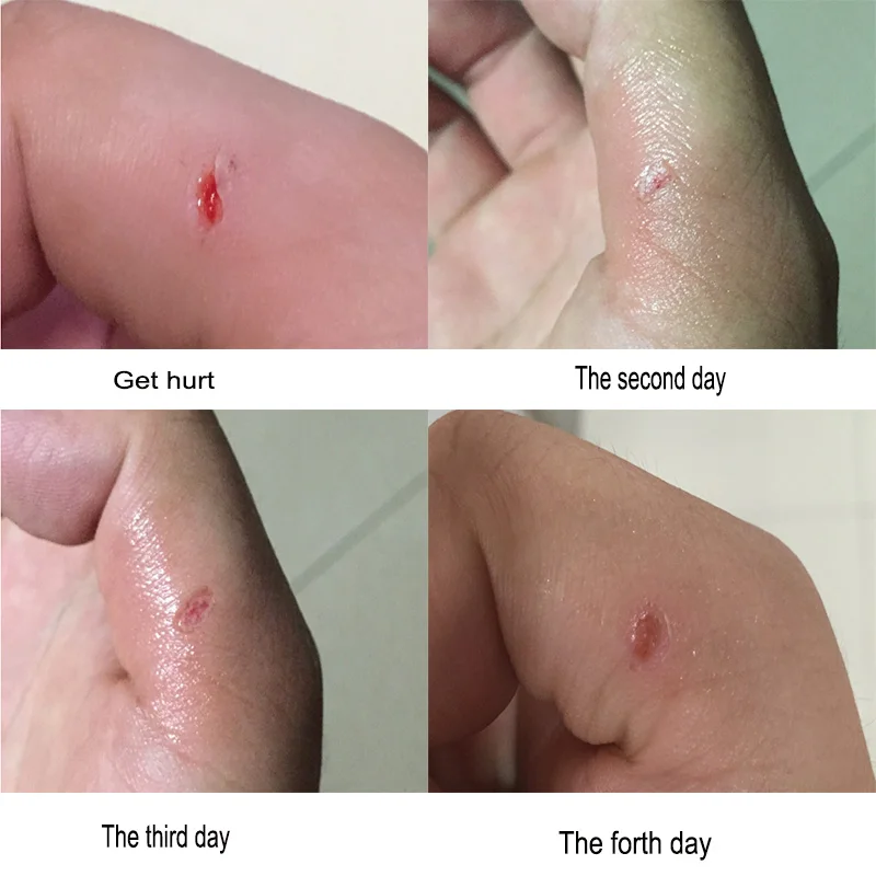 

Family nursing Germany Liquid band-aid, waterproof and Breathable Hemostasis Sterile Quick Drying sterilization First Aid spray