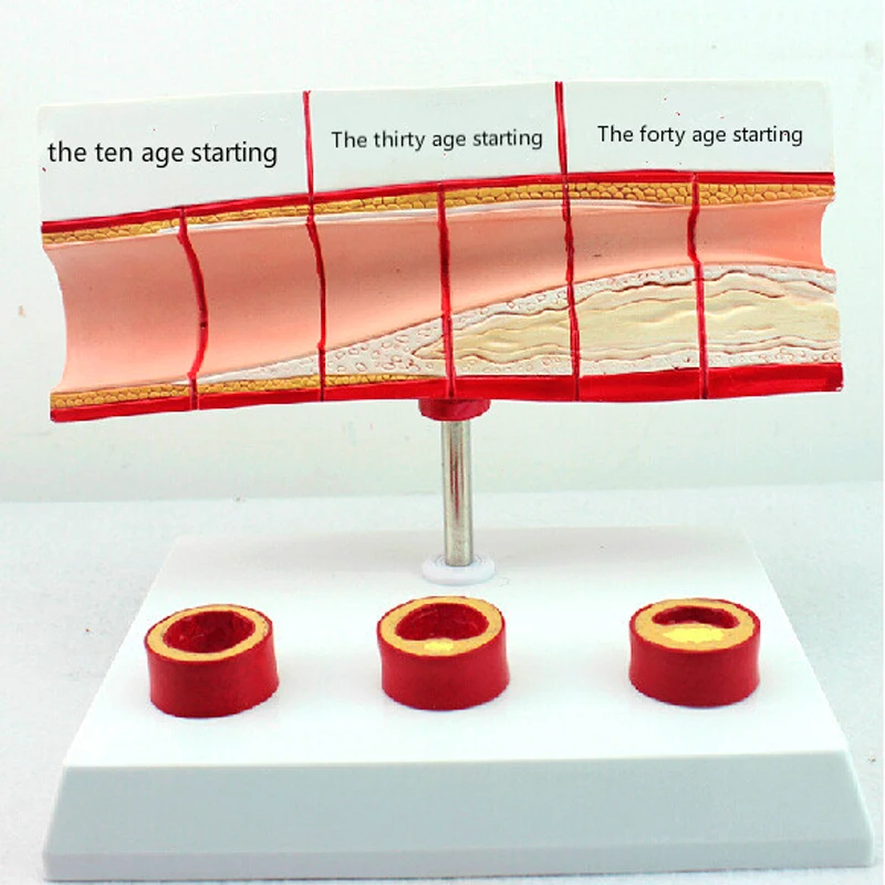 Подлинная модель кровяного холестерина и возраста EasyThru коронарная болезнь