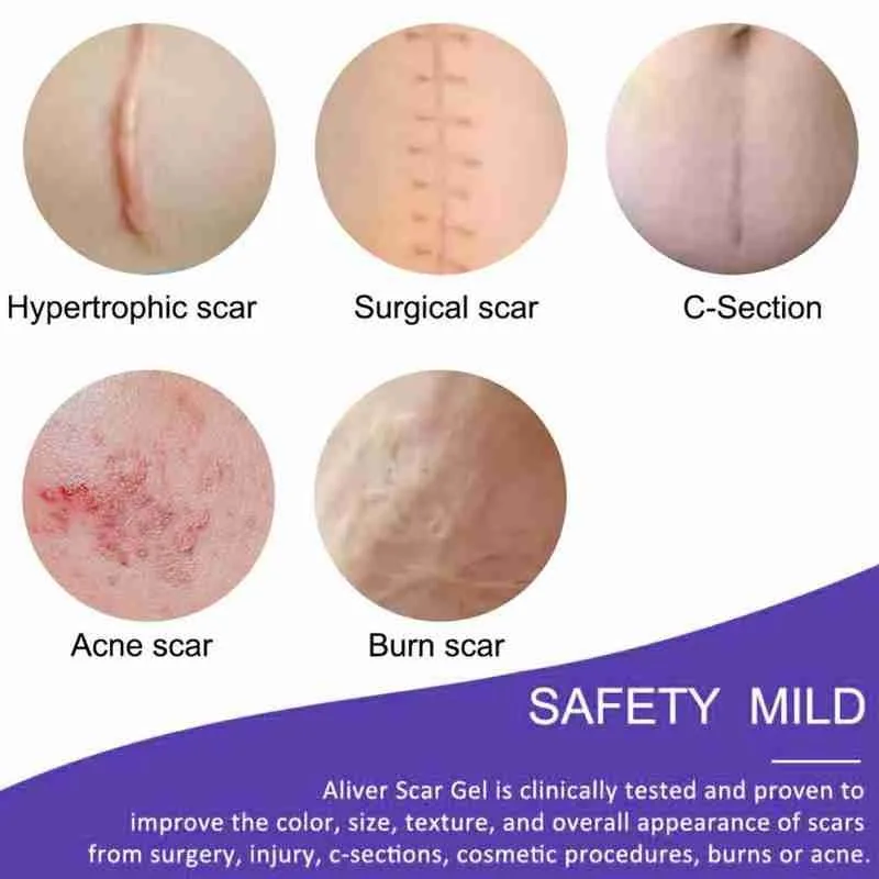 

Reusable Silicone Scar Sheets Improves heals and lightens Sheet Remove Repair Long-lasting scars Acne Burn Skin Trauma R9K4
