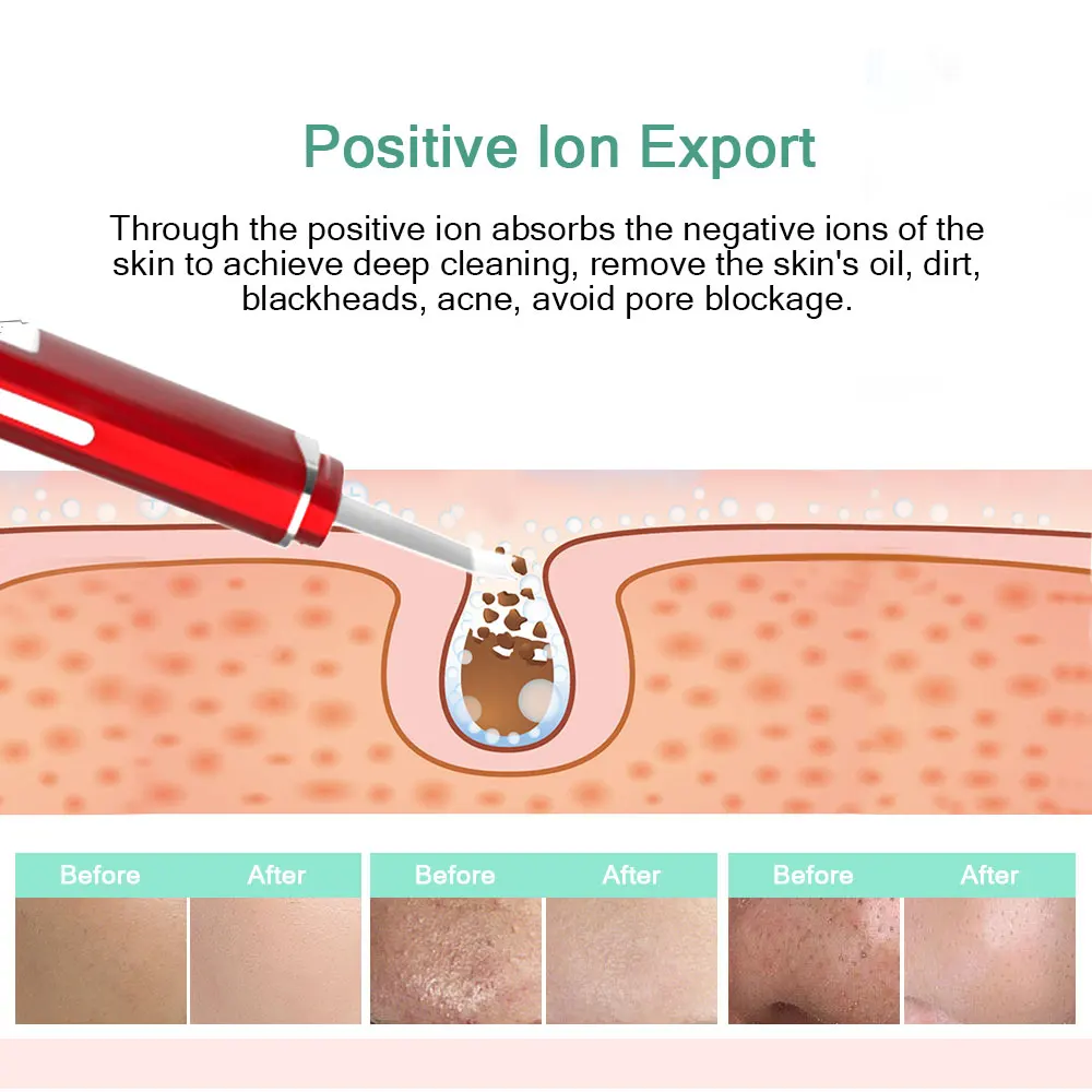 Ультразвуковой скребок для кожи ANLAN устройство глубокой очистки лица удаления