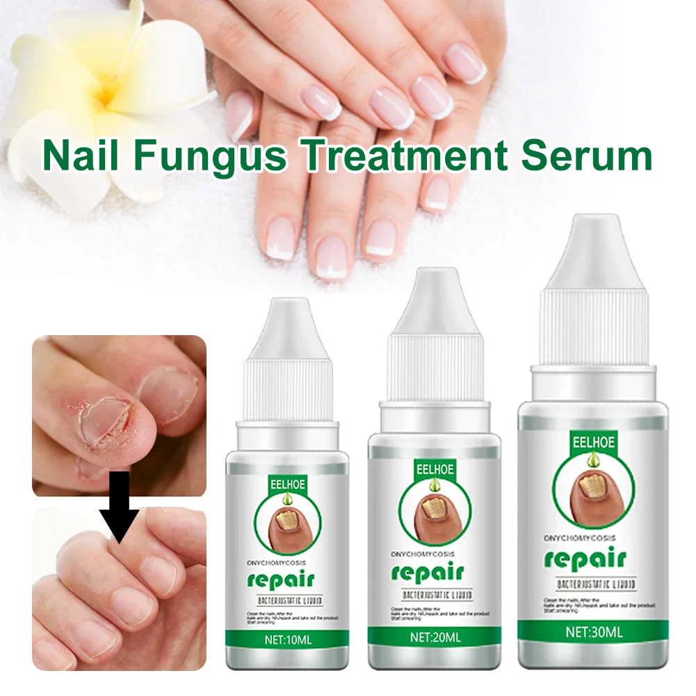 

Nail Fungal Treatment Serum Feet Care Fungus Fingernails and Toenails Repair Promote New Growth Renew Cracked Fungal for Nails