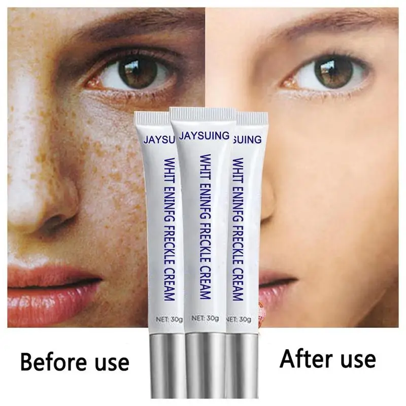 Blemish Cream Freckles Acne Pimple Scar Dark Spots Remove Skin Whitening Brightening