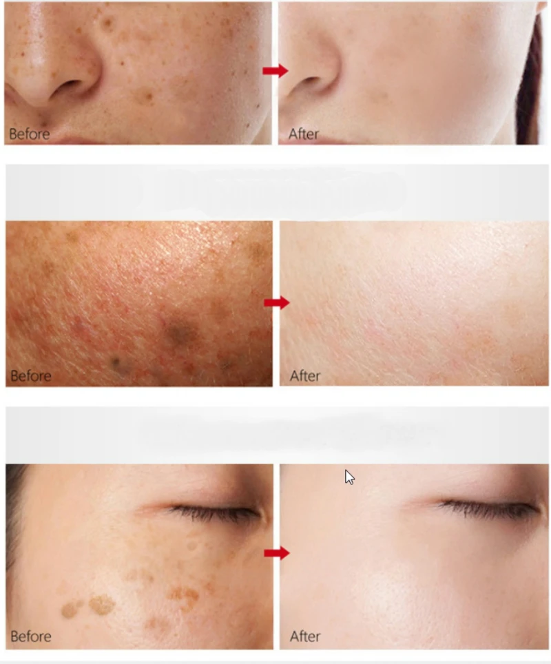 Dimollaure Retinol cream Vitamin C peptides serum whitening acne treament Remove Freckle melasma Melanin dark Spots | Красота и