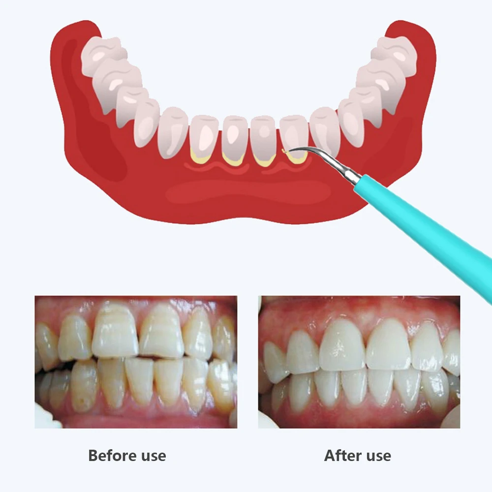 Teeth Whitening Electric Dental Scaler Tooth Calculus Remover Dentist Plaque Hygiene | Бытовая техника