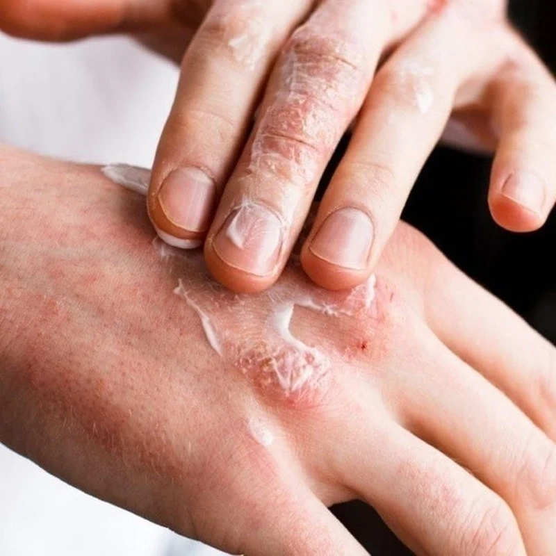 100% оригинальный крем от псориаза Антибактериальный противозудный дерматит