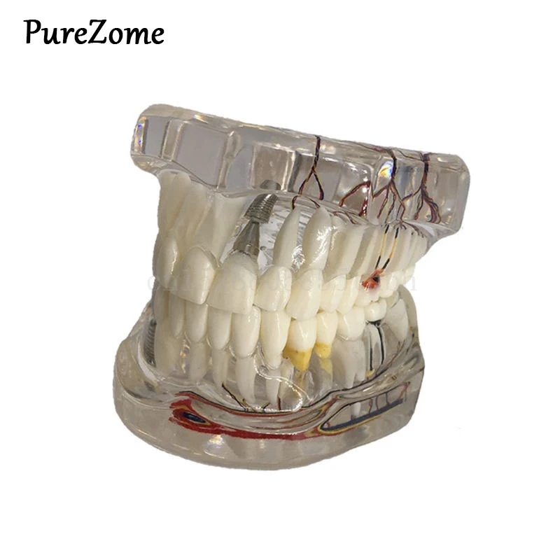 

Dental Disease Implant Teeth Model with Restoration Bridge Tooth Dentist for Medical Science Disease Teaching Study