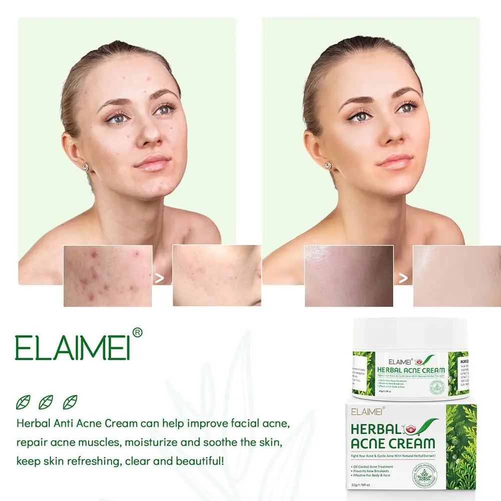 

Acne Scar Stretch Marks Remover Cream Face Cream Skin Whitening Care Spots Blackhead Face Repair Acne Cream Treatment V7Q2