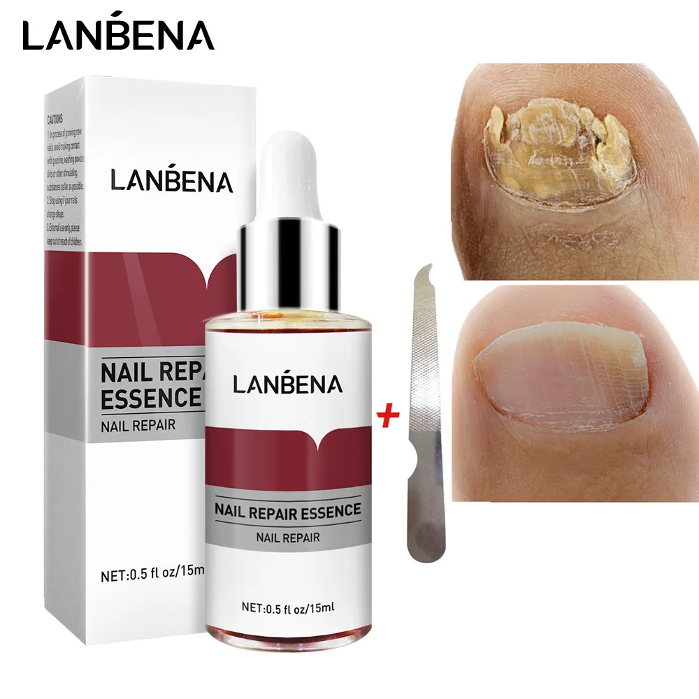 

LANBENA Fungal Nail Treatment Essence Toe Repair Serum Fungus Removal Anti Infection Paronychia Onychomycosis Hand Foot Care