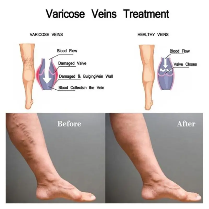 

20ml Varicose Veins Treatment Cold Therapy Cream Gel Effective Improve Vasculiti