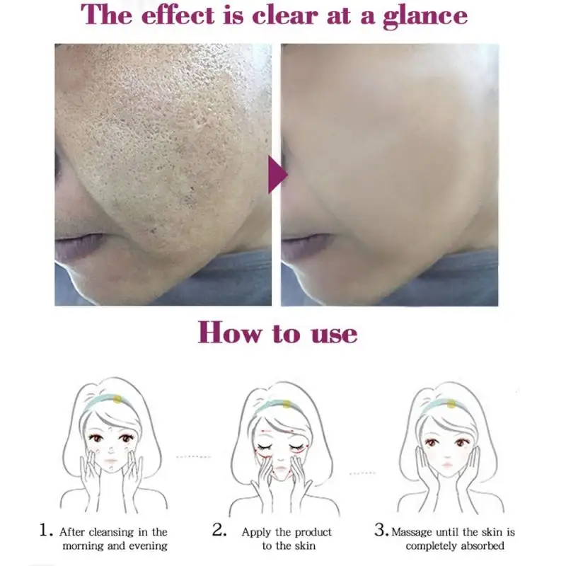 

RtopR 15 ml Acne Treatment Blackhead Oil Control Removal Anti Acne Cream Shrink Pores Acne Scar Remove Face Care Whitening