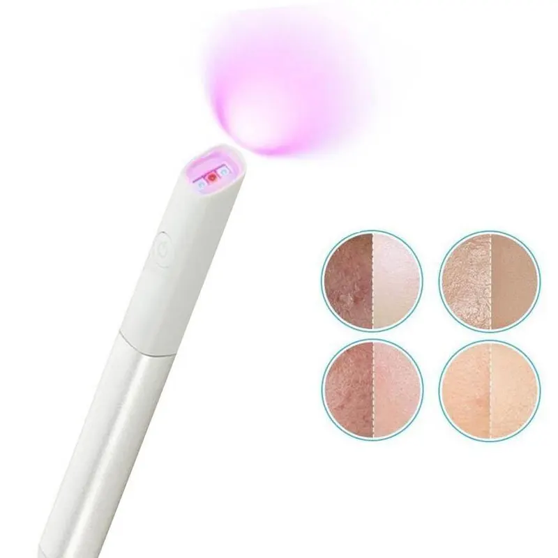 Лазерная ручка для лечения пятен акне черных точек и рубцов|Устройство ухода за