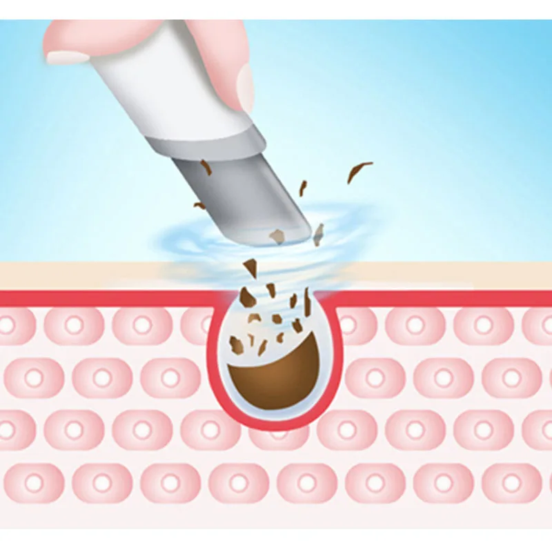 Сверхтонкий кислородный прибор для очистки пузырьков водорода инъекция