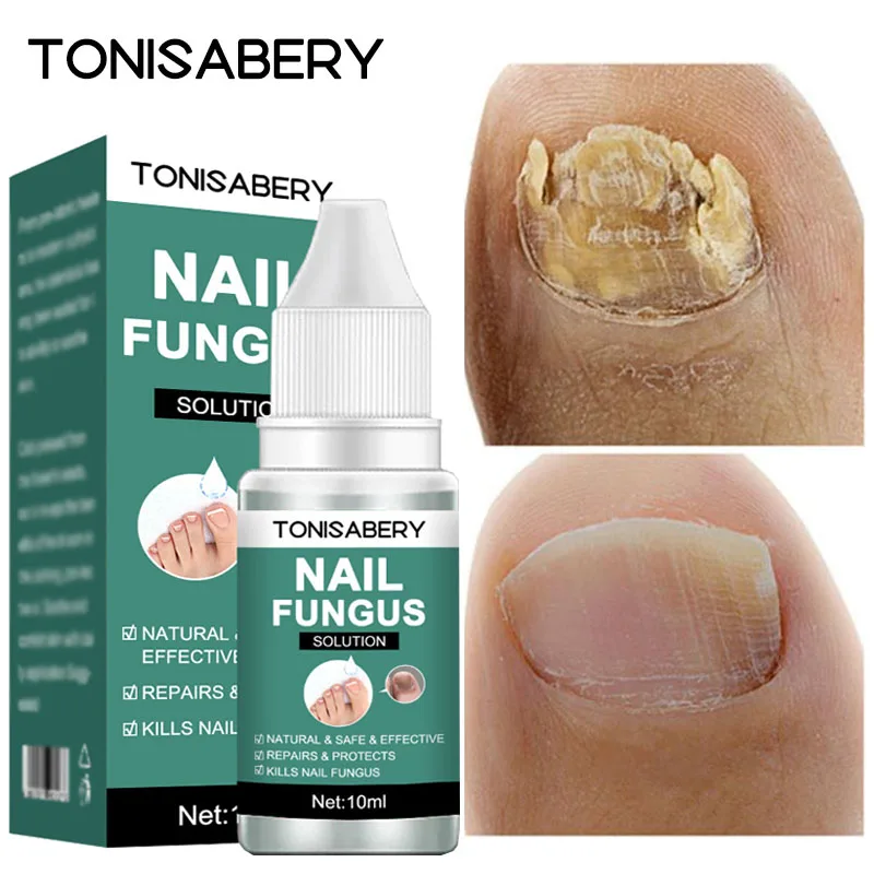 Nail Fungal Treatment Feet Care Essence  Anti Infection Paronychia Onychomycosis Nail Foot Toe Nail Fungus Removal Gel Products
