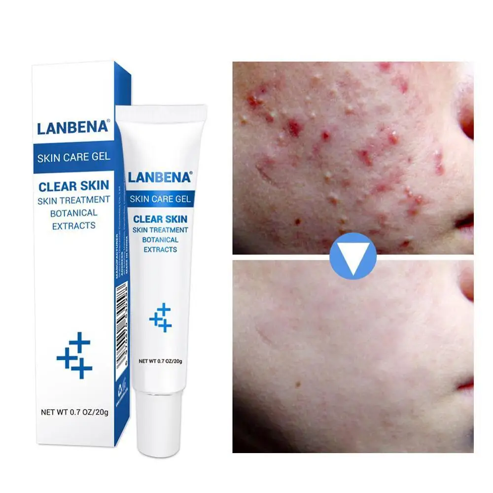 LANBENA увлажняющий гель крем против акне контроль над маслом сужение пор жирная