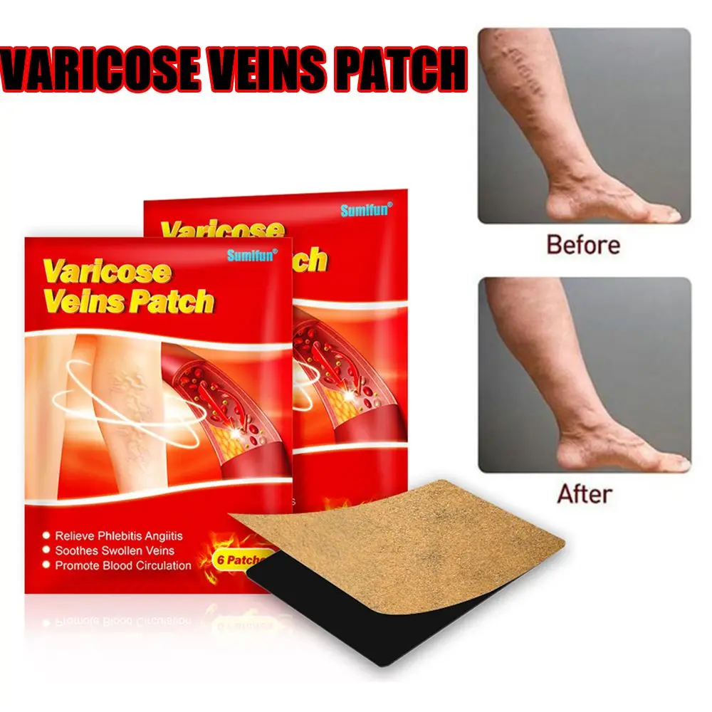

Medicine Phlebitis Angiitis Blood Vessel Rotten Varicose Veins Patches Ointment Health Care Treatment Vasculitis Cream