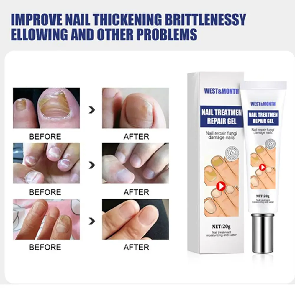 

new whitening Toe nail protection, ​Bactericidal Nail Treatment Oil Hand ​cream foot cream Fungus Removal