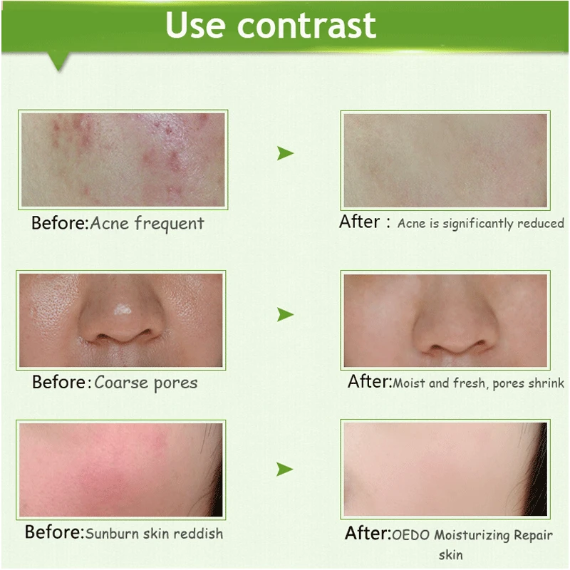 Гель для Кожи с алоэ вера уход за дополнительным питанием увлажнение