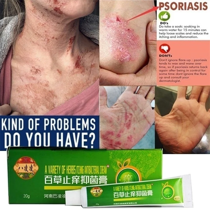 100% оригинальный крем от псориаза Антибактериальный противозудный дерматит