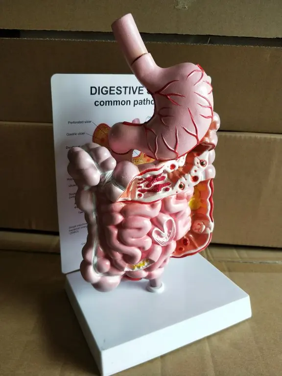 Human gastrointestinal pathology model doctor-patient communication demonstration model digestive system disease teaching model