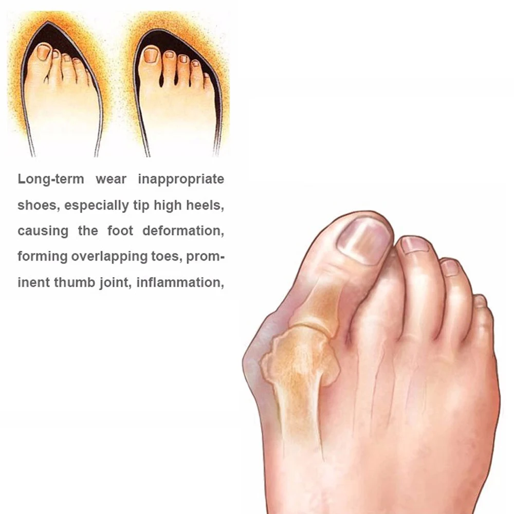 Вальгусная коррекция при вальгусной деформации болях в ногах Z25601(01) | Красота и