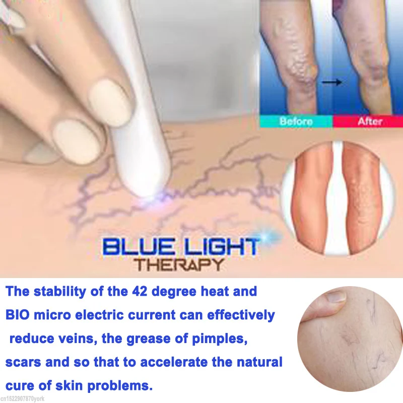 1pc Portable Medical Blue Light Therapy Acne Laser Pen Skin Spots Removal Anti Varicose Spider Vein Eraser Treatment | Красота и