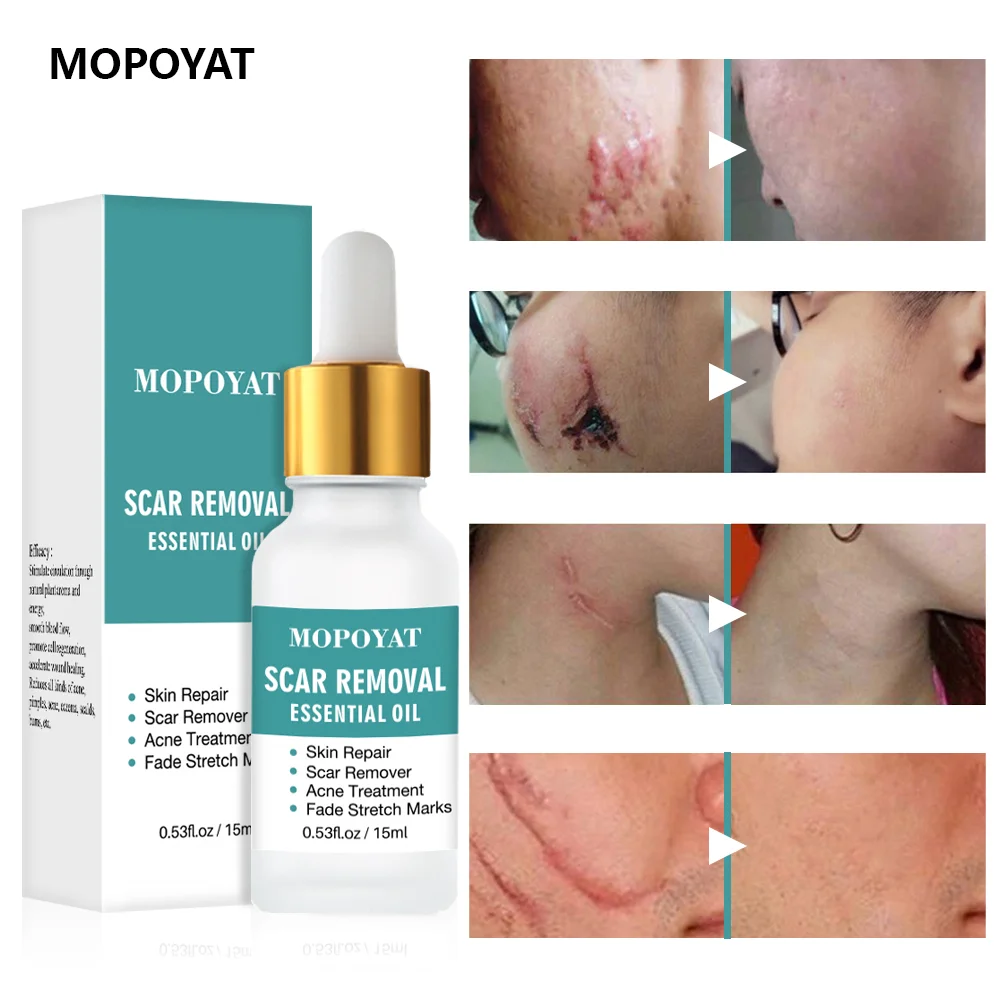 Лечение шрамов эфирное масло для лечения прыщей ремонт шрамы прибор удаления