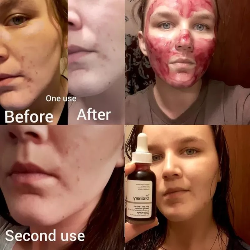 Niacinamide 10% Отшелушивающий раствор AHA 30% + BHA 2% Гиалуроновая кислота отбеливающий
