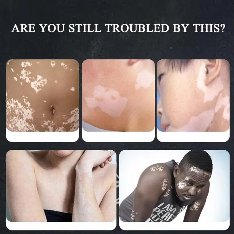 Chinese doctor of white spots pigment melanin cream promotion Liniment skin Vitiligo lekoplakia disease treatment 30g | Красота и