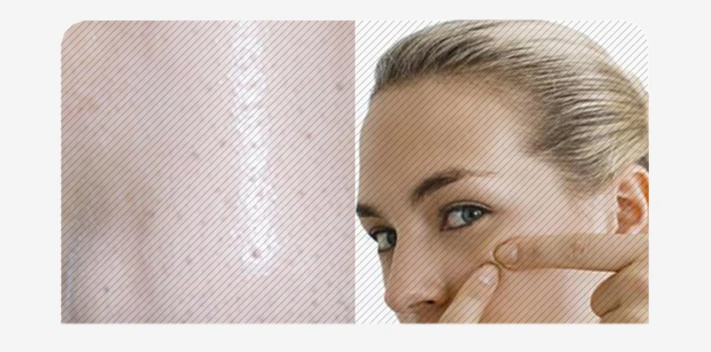Blackhead Remover Vacuum Suction Face Deep Pore Cleaner Electric Acne Pimple Remover Tool Dark Spot Remover for Face Beauty Tool