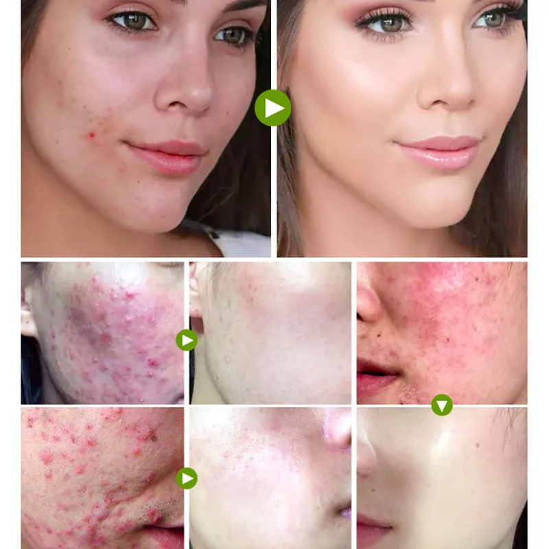 Крем для лица чайное дерево крем удаления шрамов от акне ухода за кожей