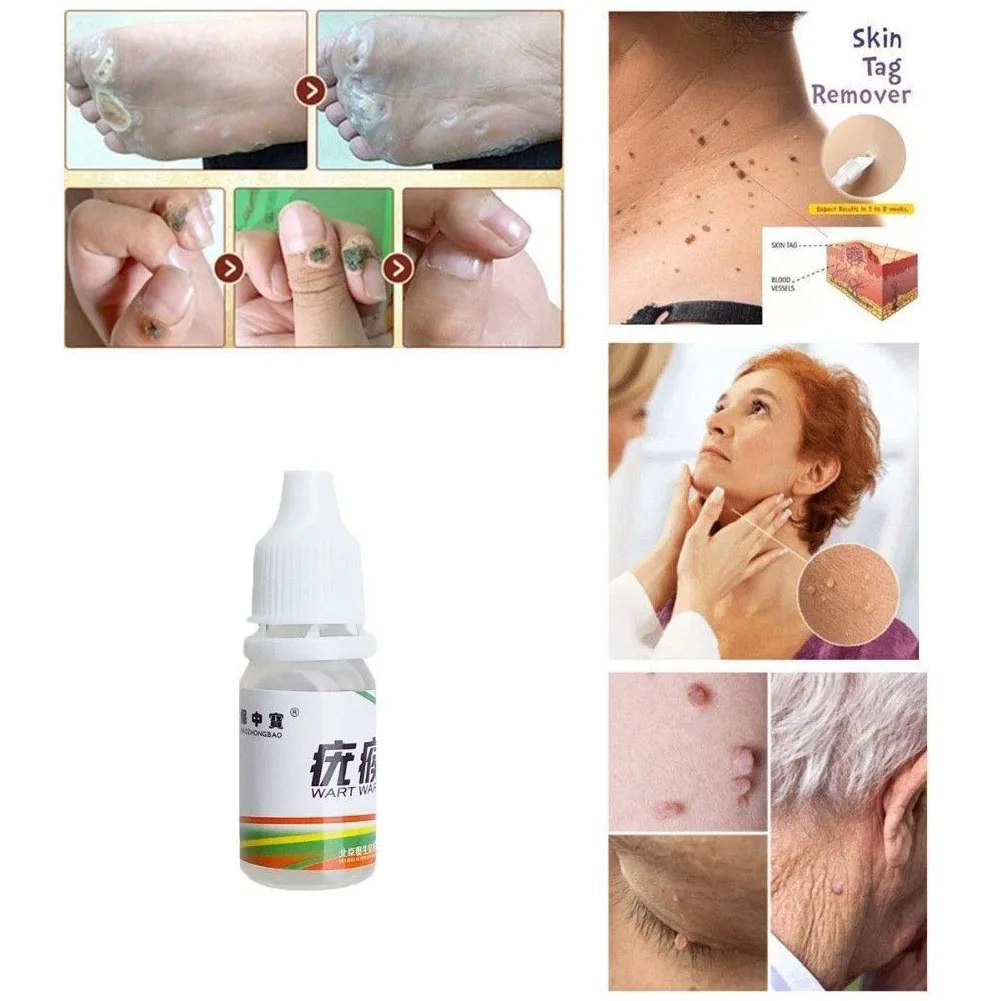 Body Skin Care Medical Tag Kill Mole Wart Remover Effective 10ml | Красота и здоровье